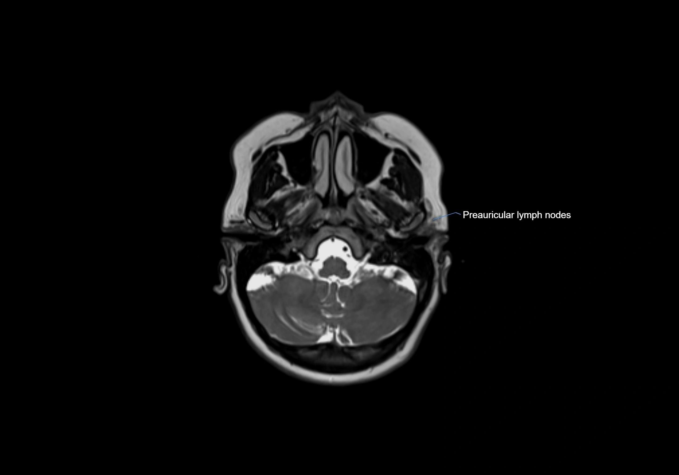 Neck axial  lymph node cross sectional MRI anatomy 3T MRI  image-img-00001-00019.webp